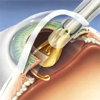 ReSTOR lens surgery illustration